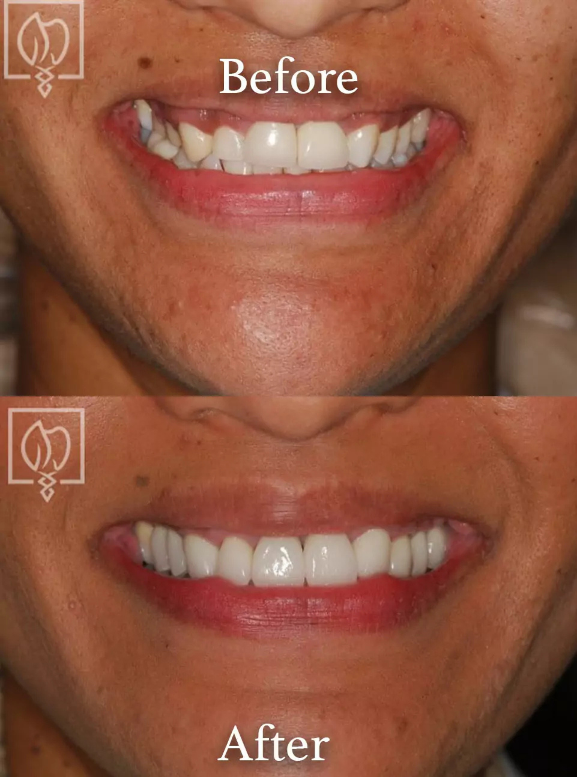 Gummy smile rehabilitation before and after case 1