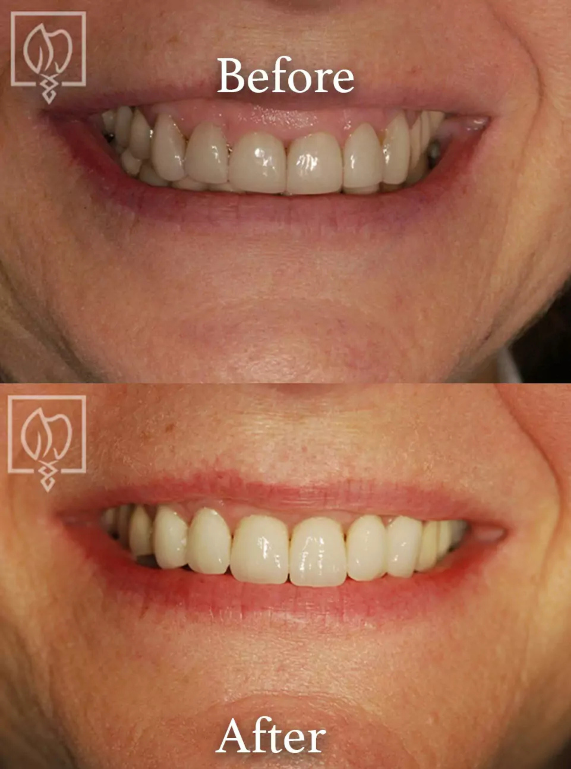Gummy smile rehabilitation before and after case 2