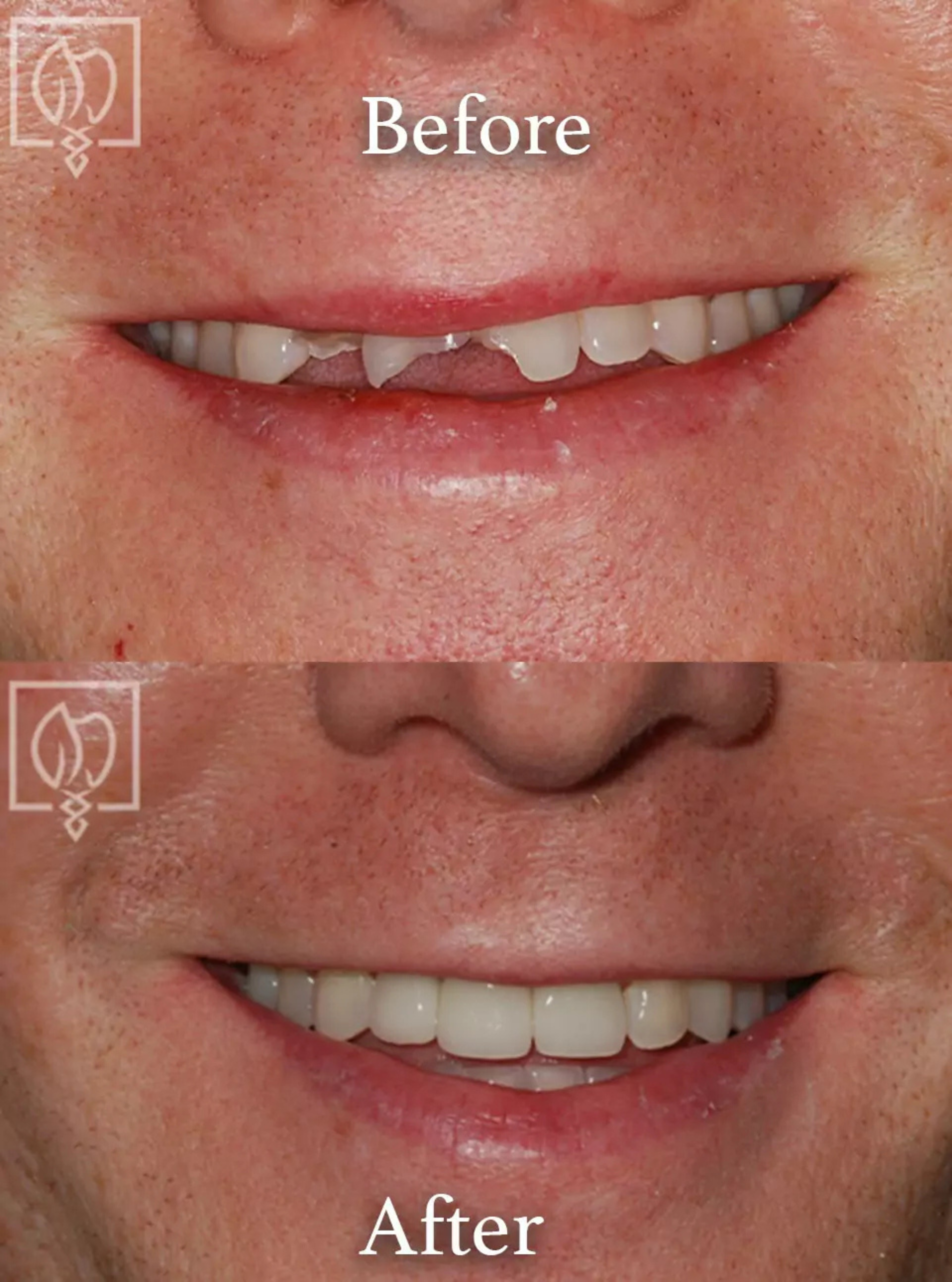 Immediate temporary dental restoration before and after case 1
