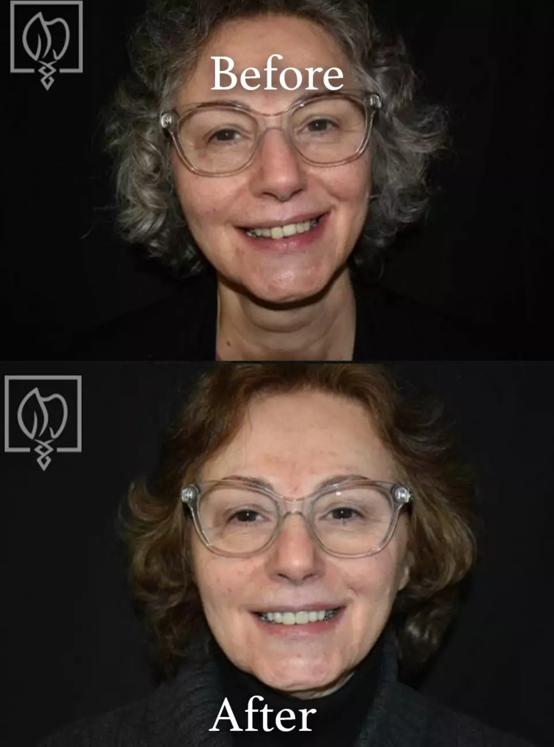 Immediate temporary dental restoration before and after case 2