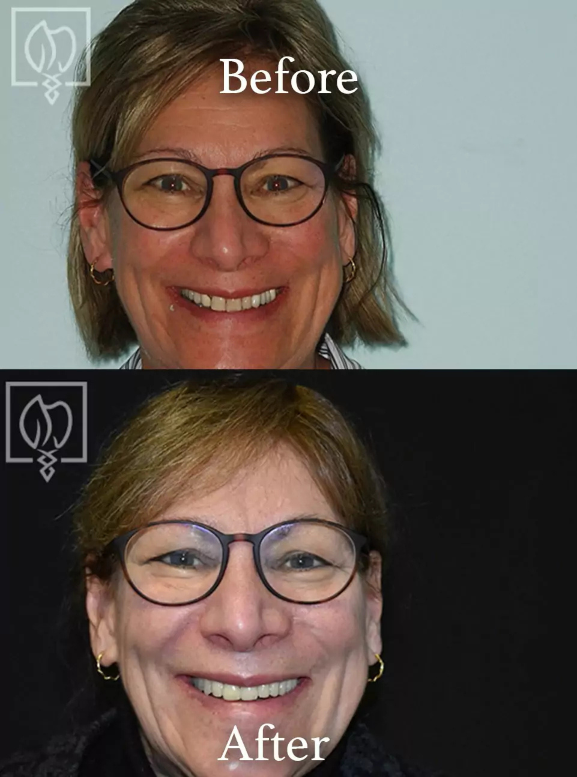 Immediate temporary dental restoration before and after case 3