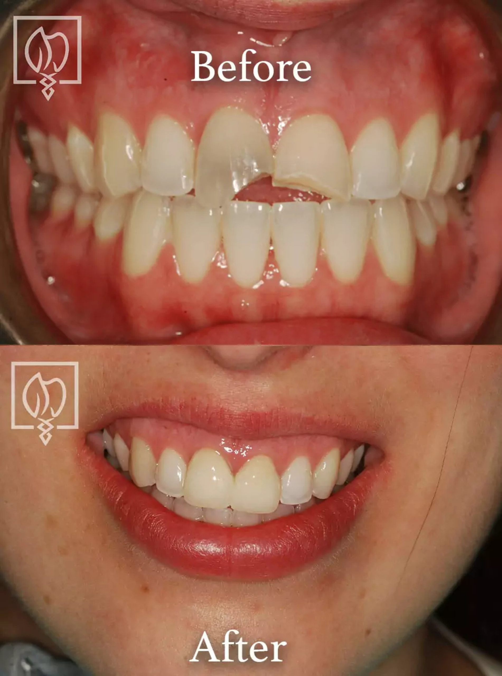 Immediate temporary dental restoration before and after case 4