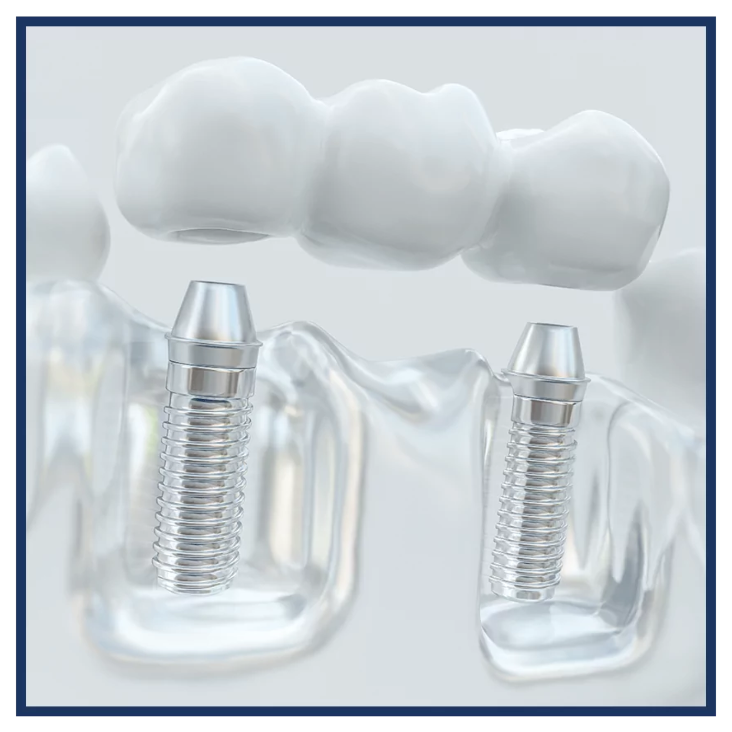 A 3D rendering shows two dental implants embedded in a transparent jawbone with a dental bridge above them, illustrating a cosmetic dentistry restoration procedure in Bethesda.