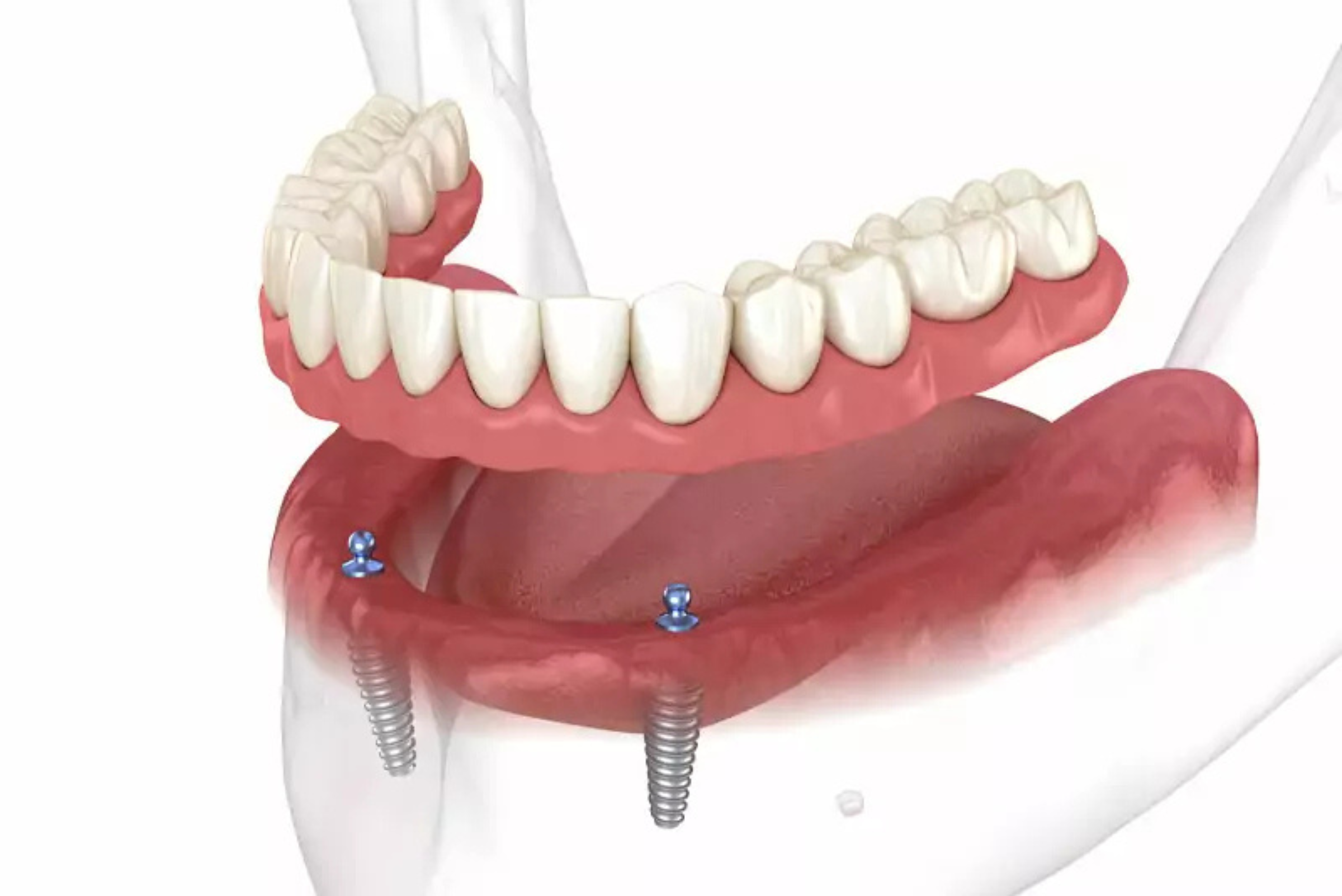 Diagram showing implant-supported dentures anchored to dental implants