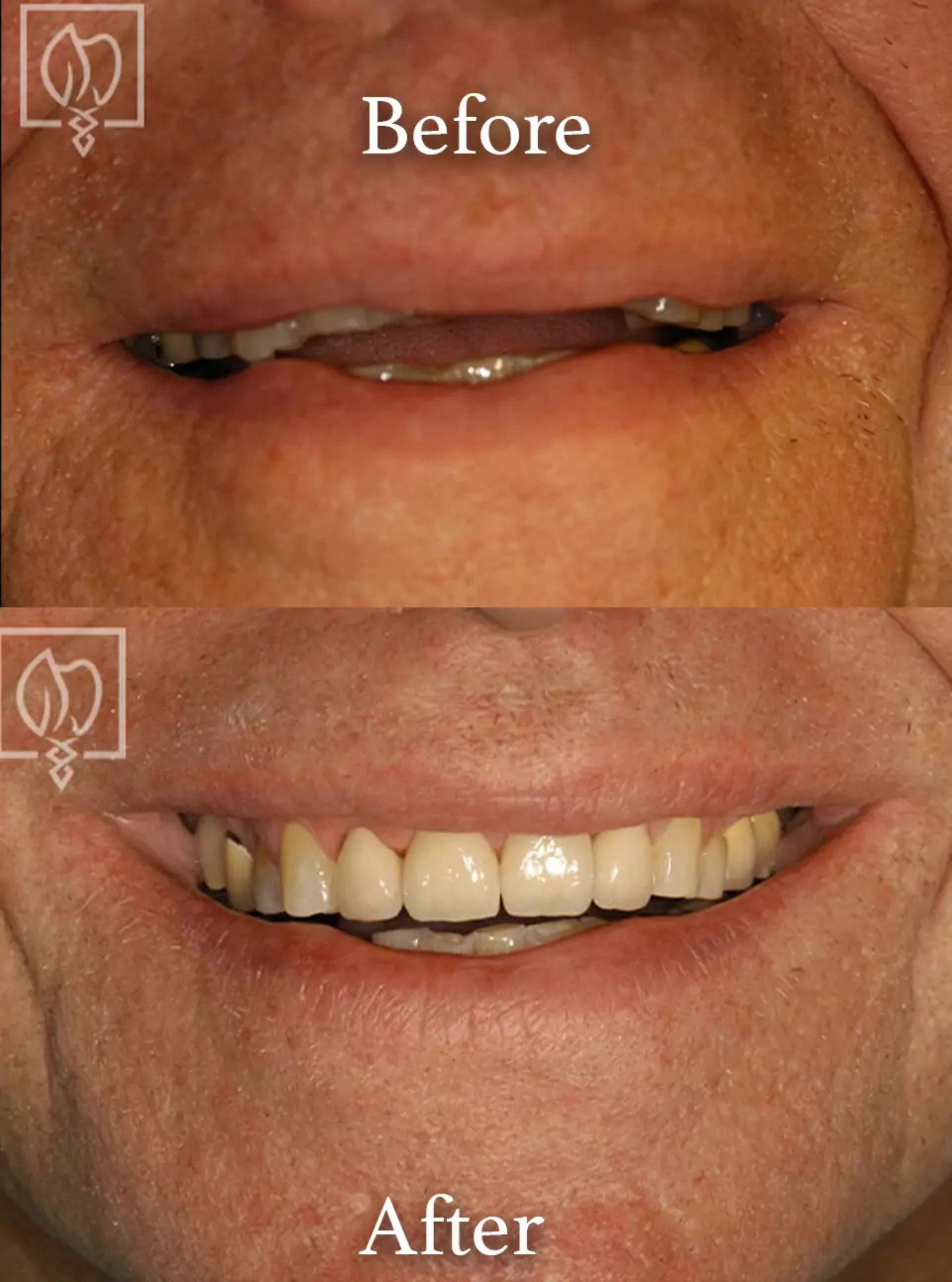 Teeth grinding damage repair before and after case 1