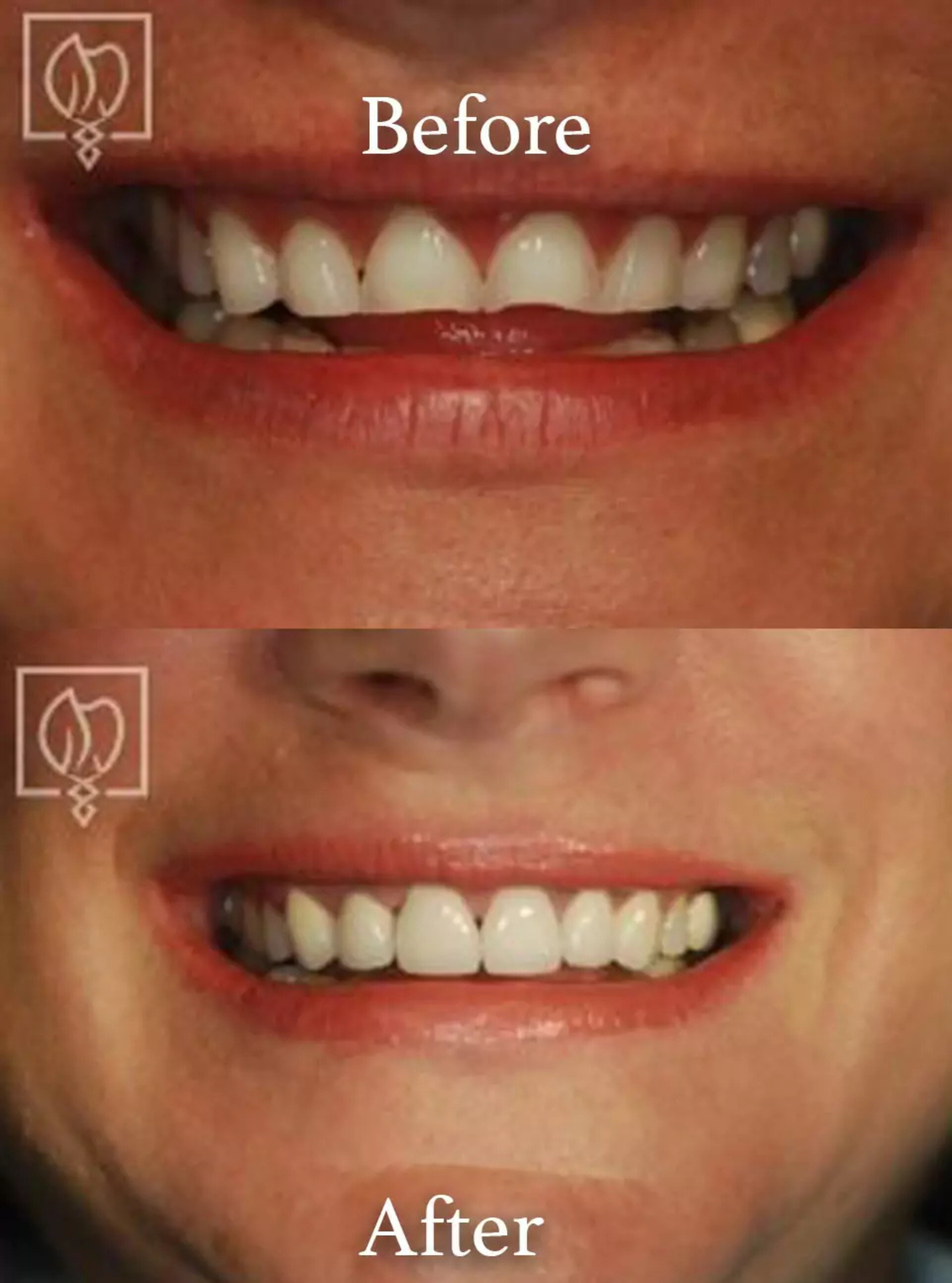 Teeth grinding damage repair before and after case 2
