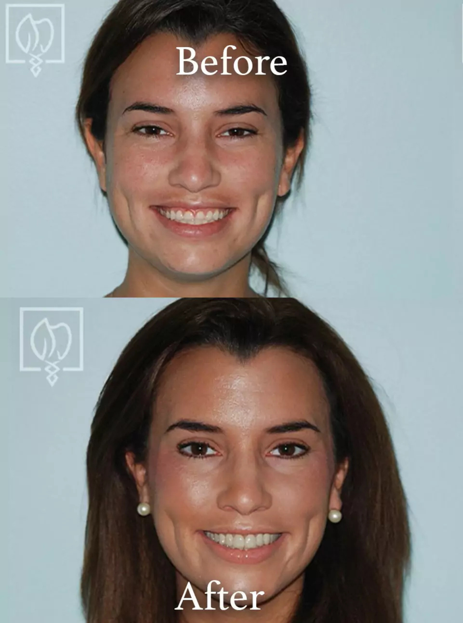 Teeth grinding damage repair before and after case 3