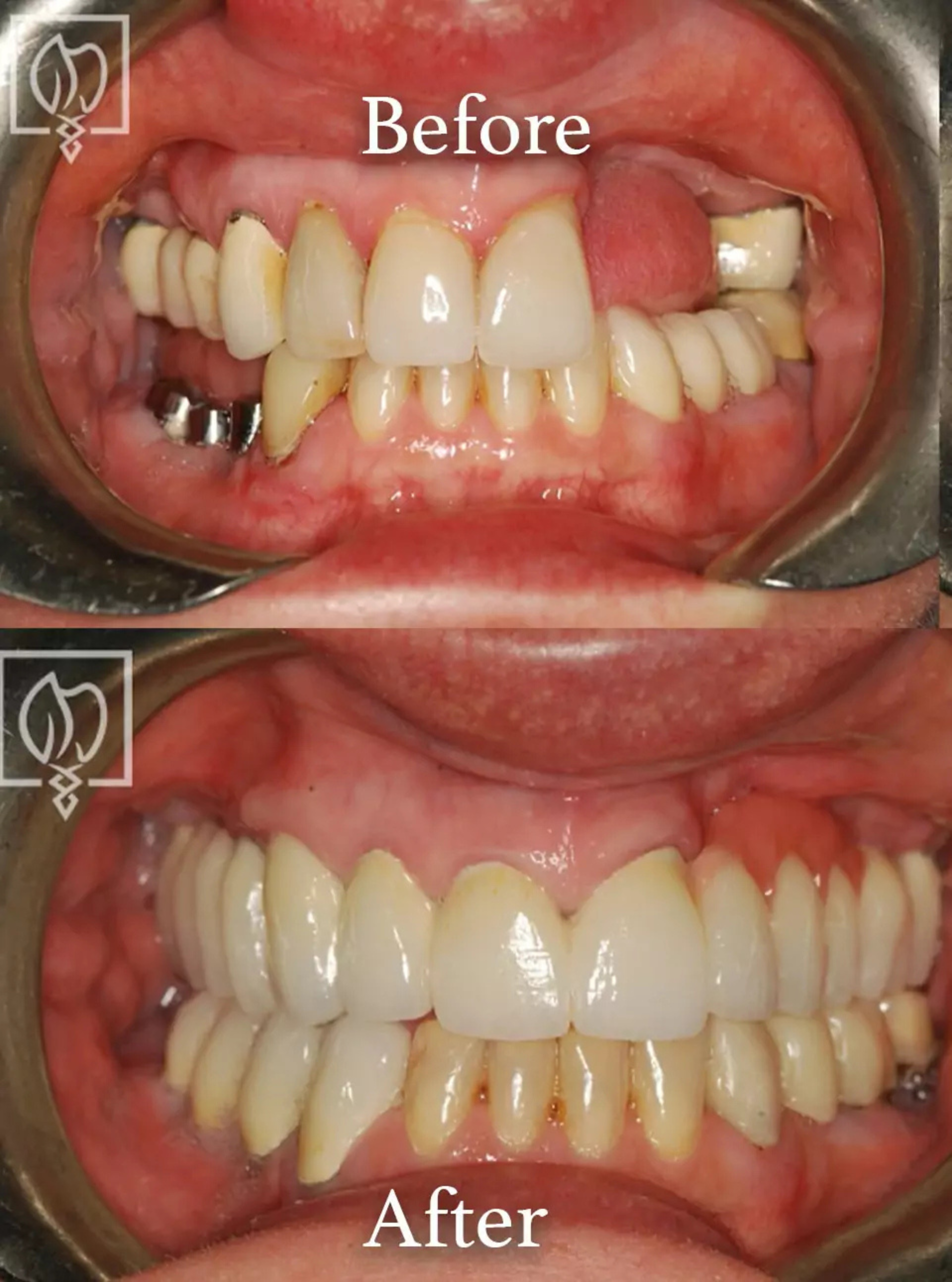 Restored failing dental implant before and after case 1
