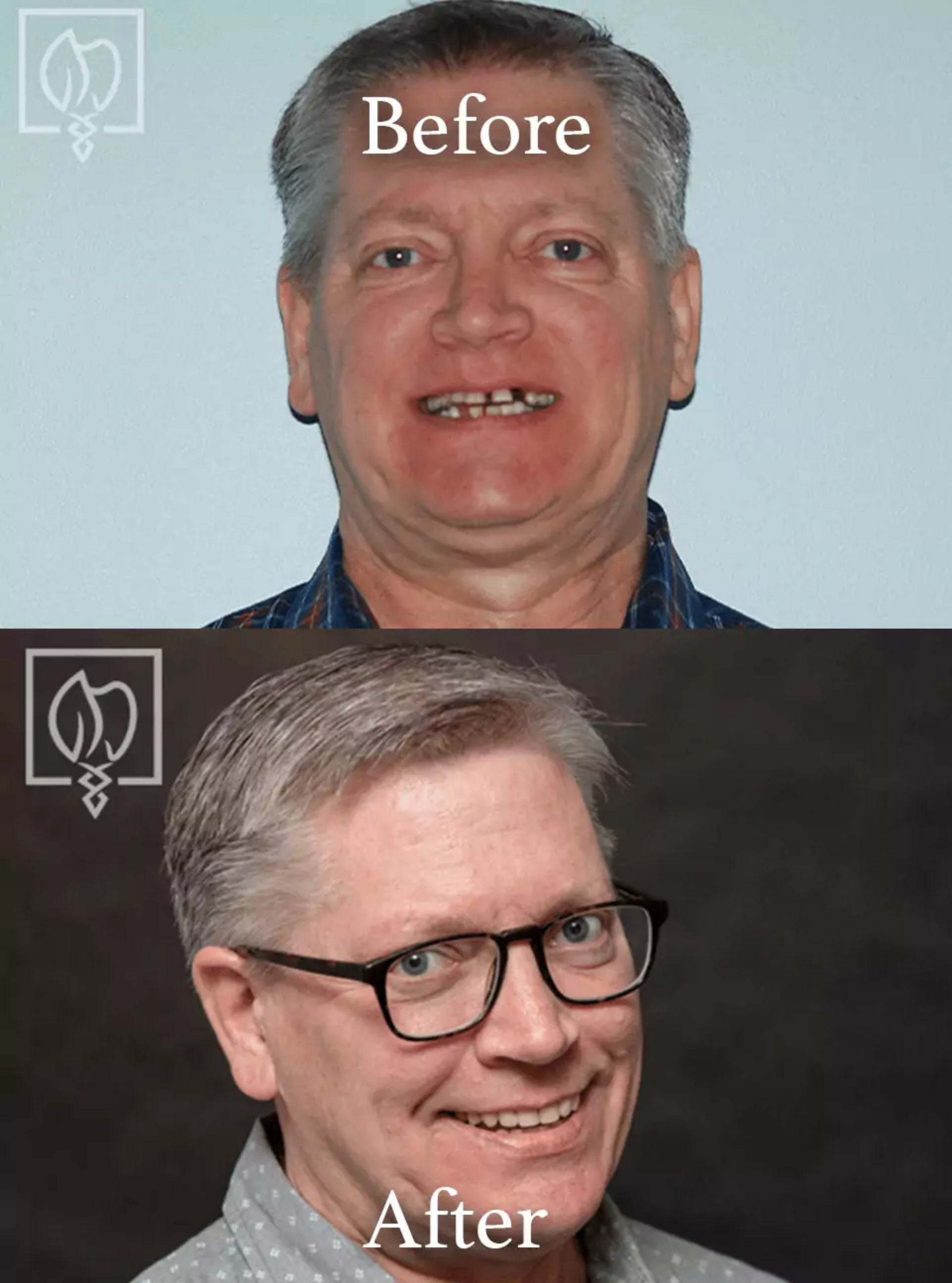 All-on-4 dental implants before and after case 1