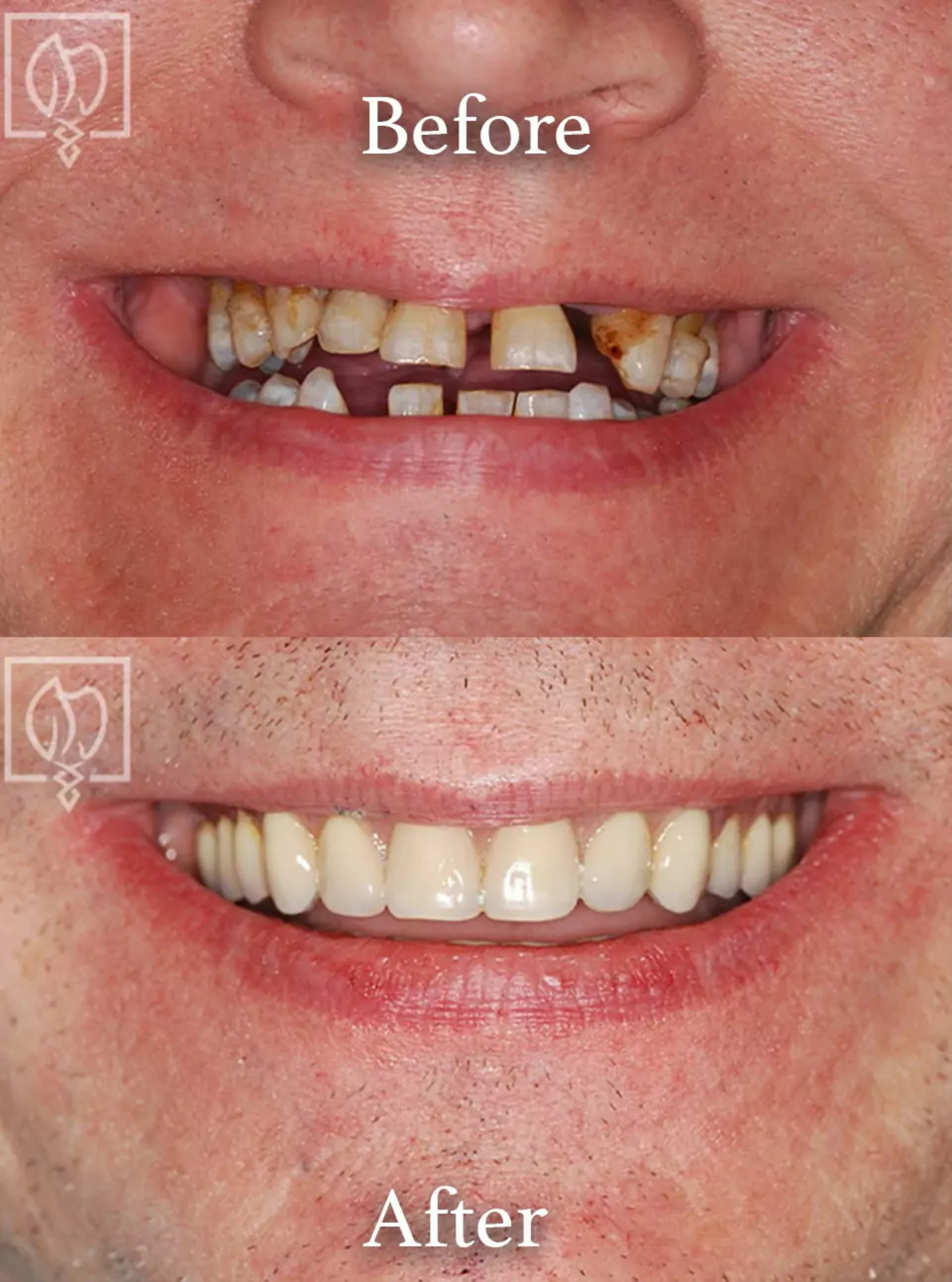 All-on-4 dental implants before and after case 2