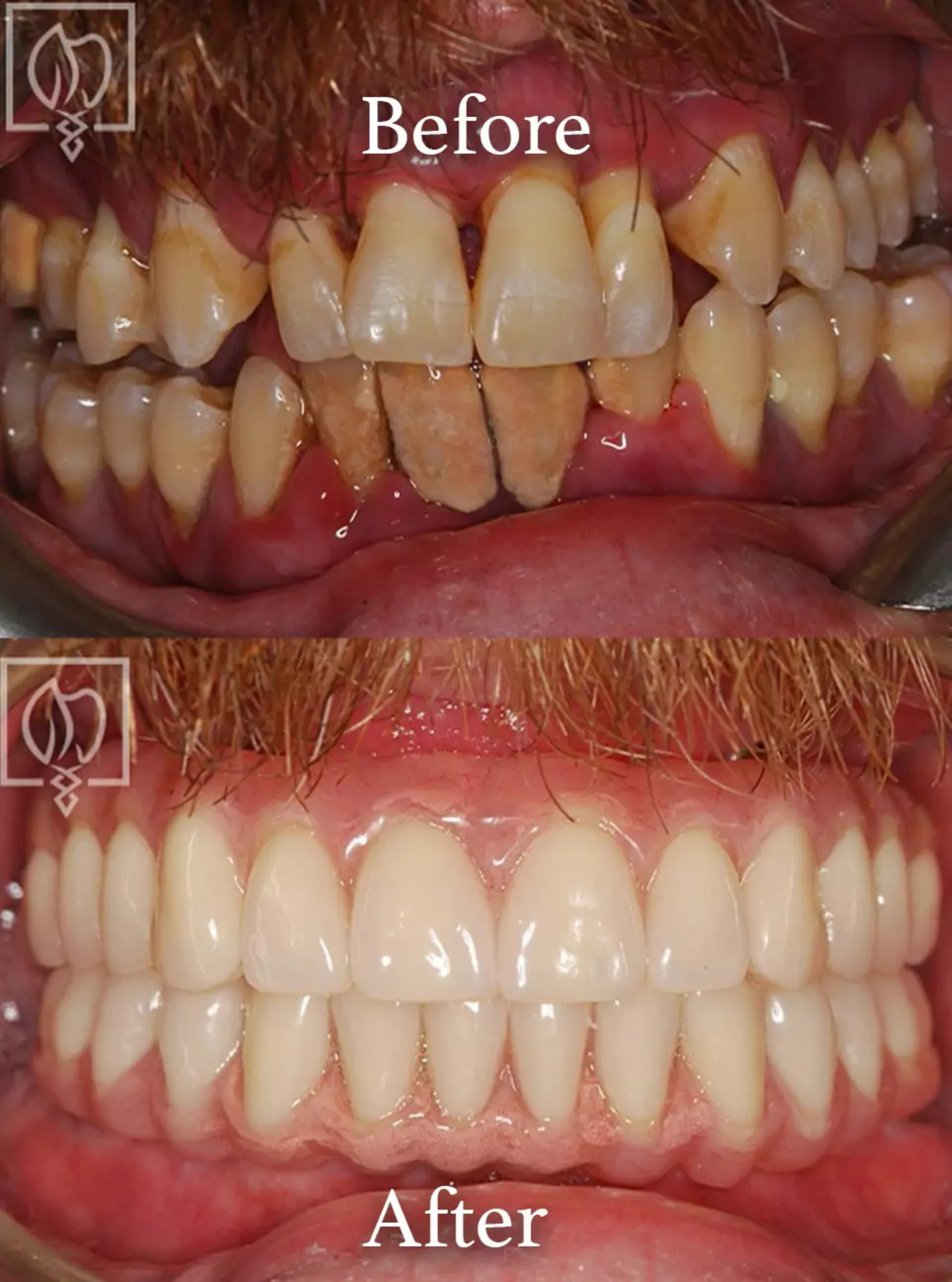 All-on-6 dental implants before and after case 3