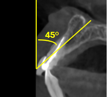 At 45 degrees, Implants Would Be Unrestorable