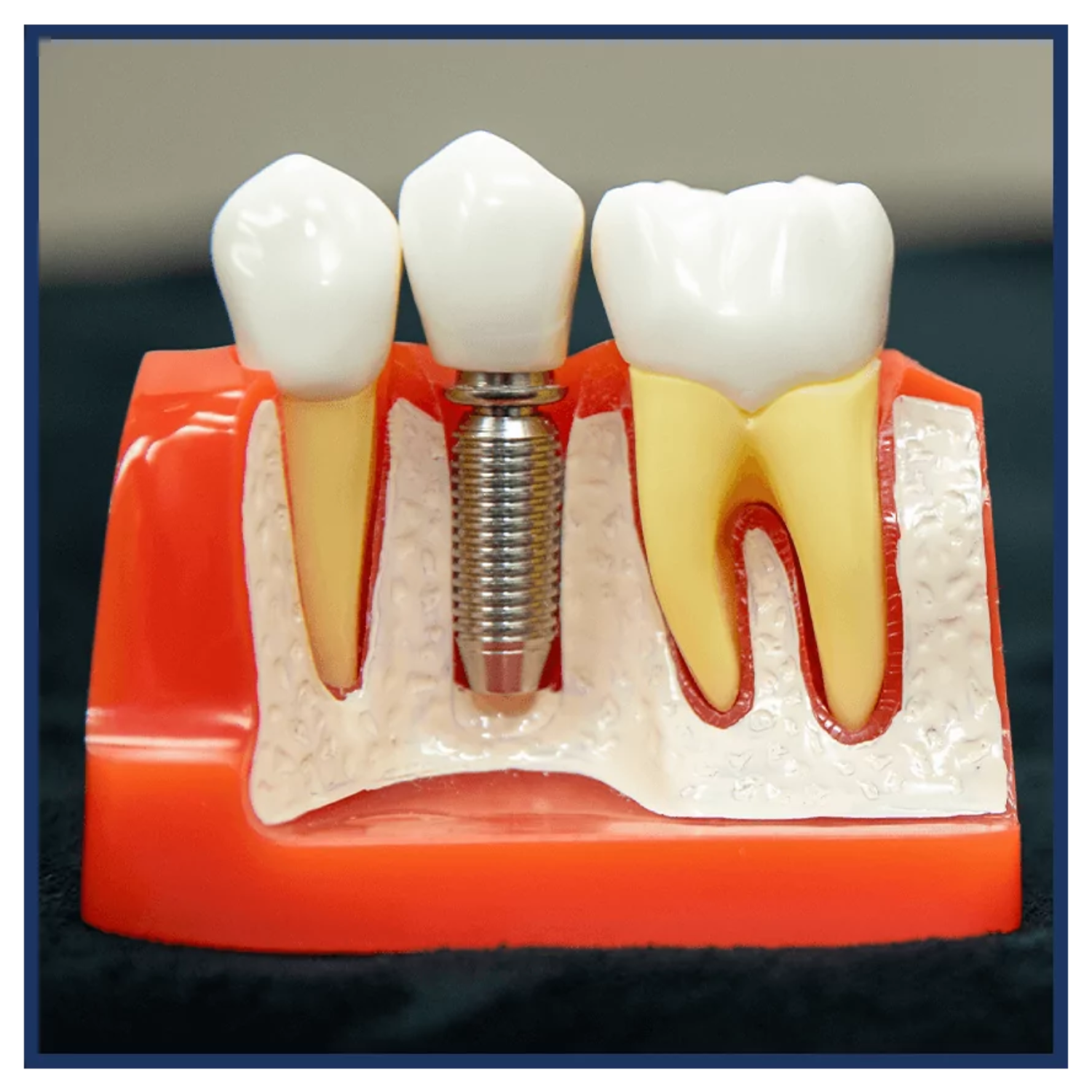 Diagram showing single dental implant placement and crown restoration