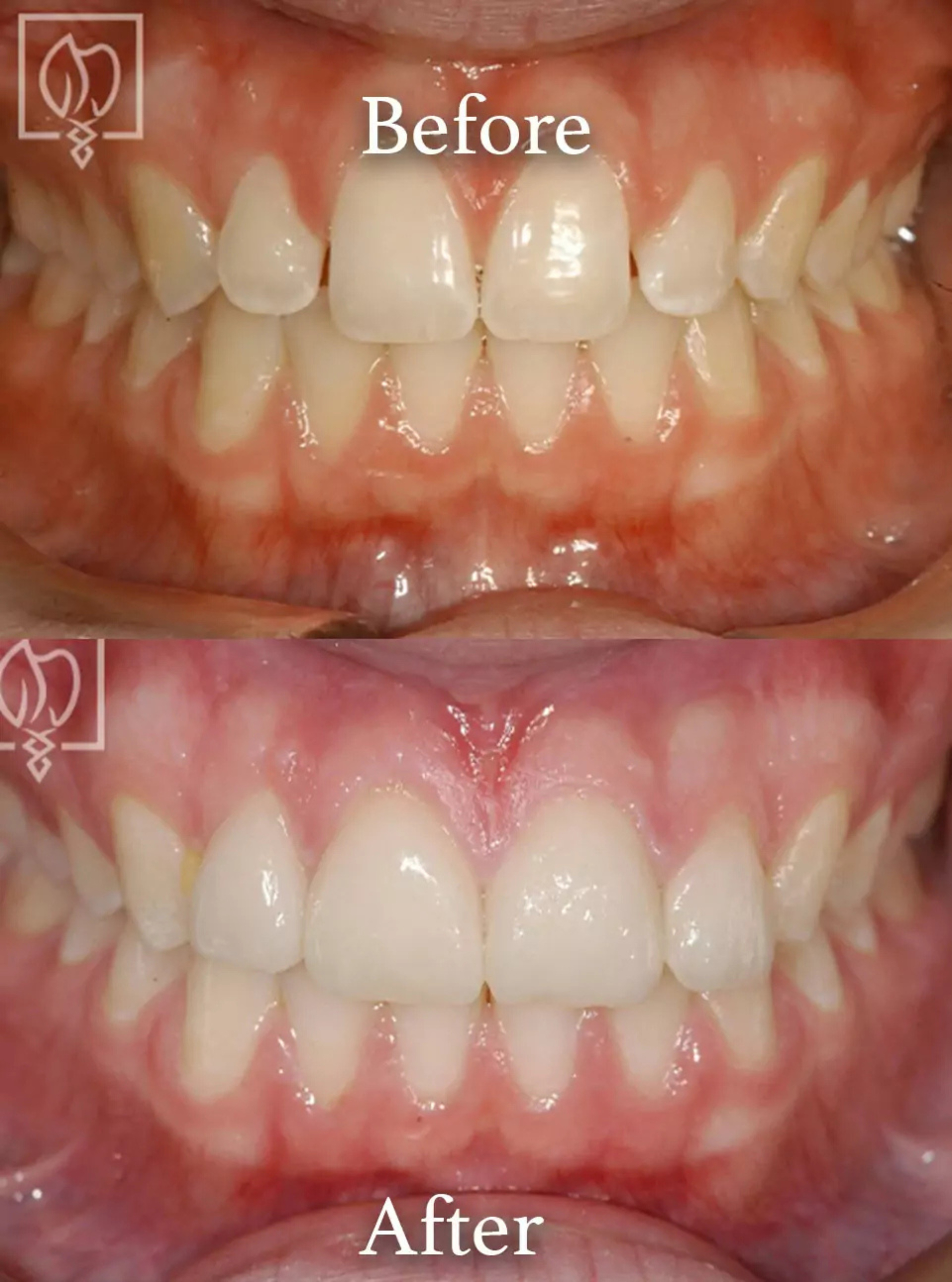 Dental veneers before and after transformation