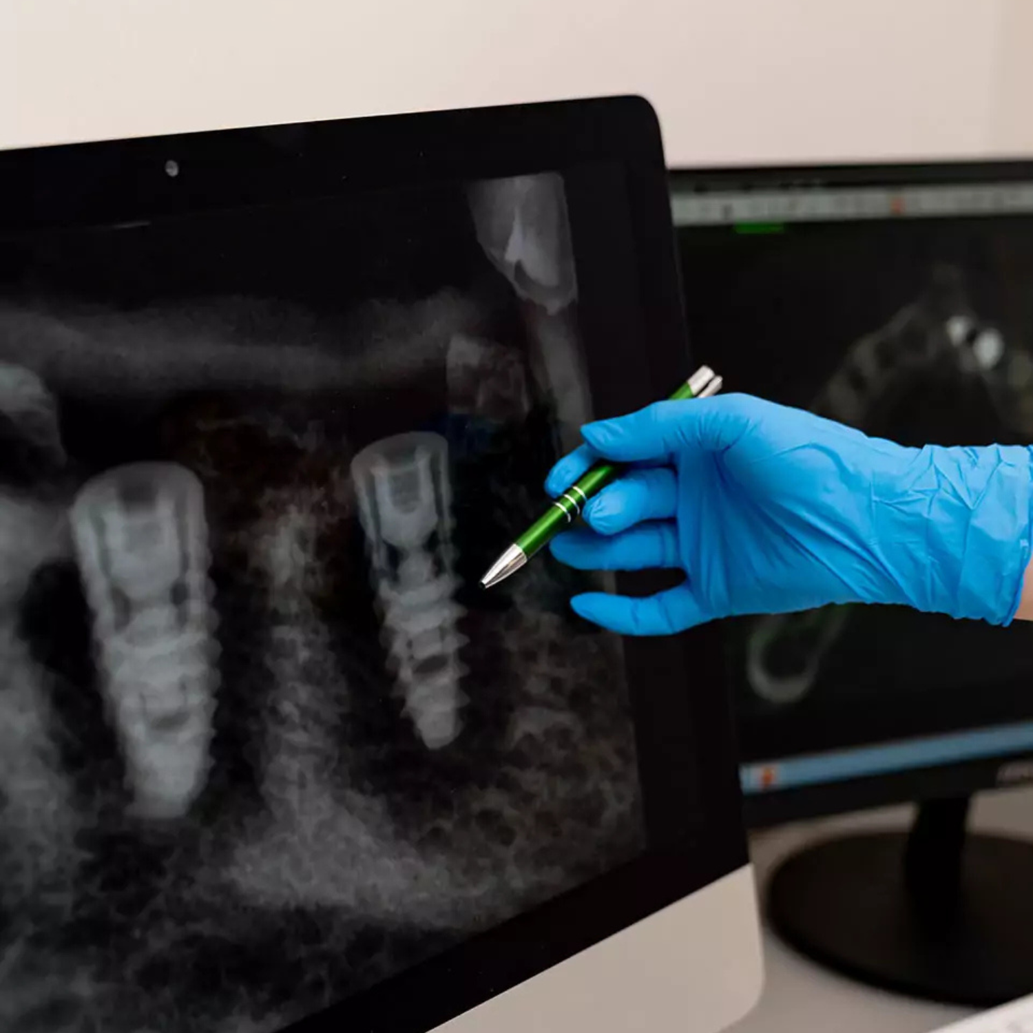 A gloved hand points with a pen at a dental X-ray on a computer monitor, showing three dental implants in the lower jaw. Another monitor is in the background. Expertise in cosmetic dentistry is available near Bethesda and Washington DC. A gloved hand points with a pen at a dental X-ray on a computer monitor, showing three dental implants in the lower jaw. Another monitor is in the background. Expertise in cosmetic dentistry is available near Bethesda and Washington DC.
