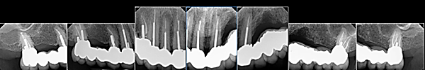 X-rays after six years showing stable full-arch reconstruction