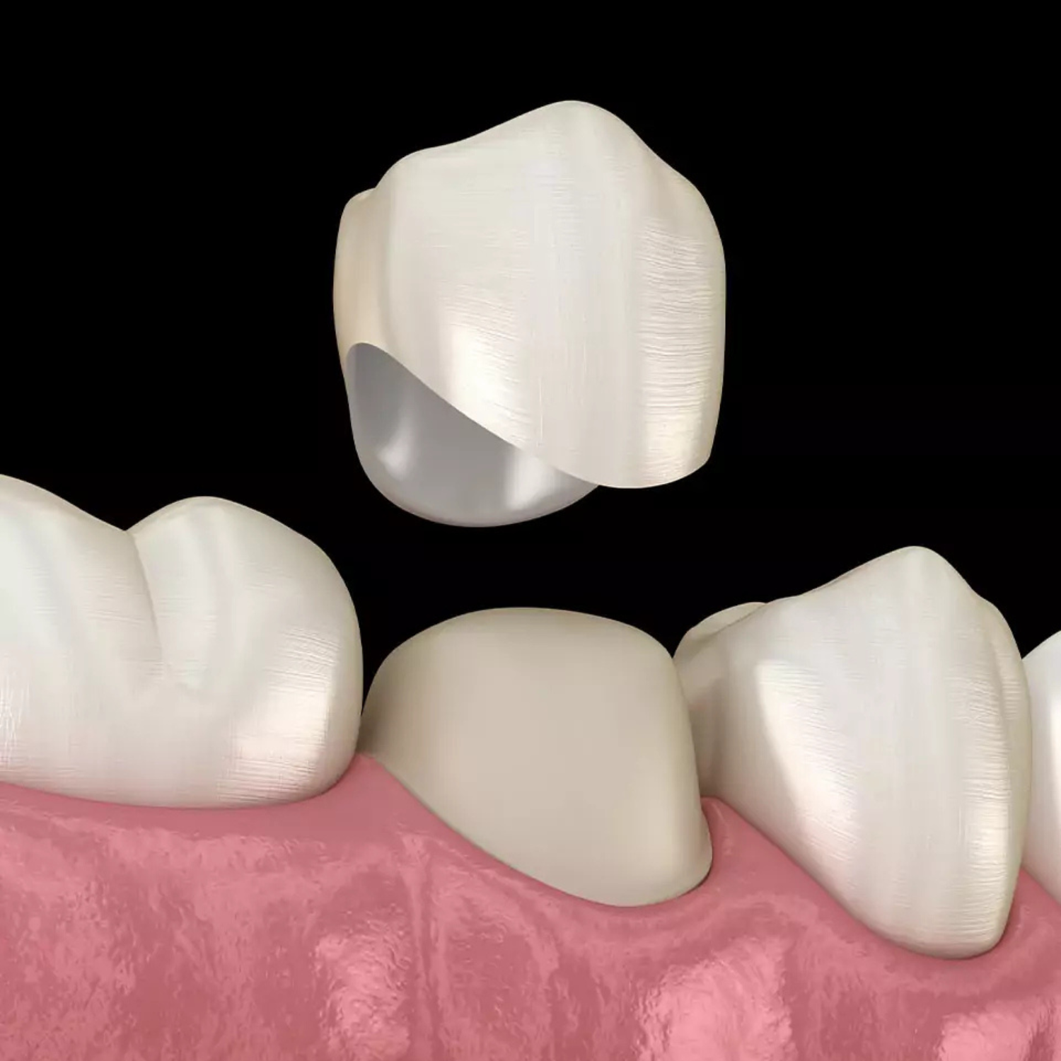 Porcelain dental crown designed for seamless tooth restoration