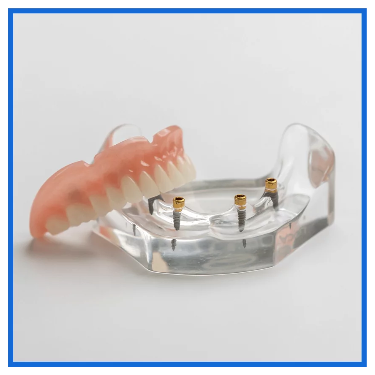 Precision-fitted partial denture on a dental model