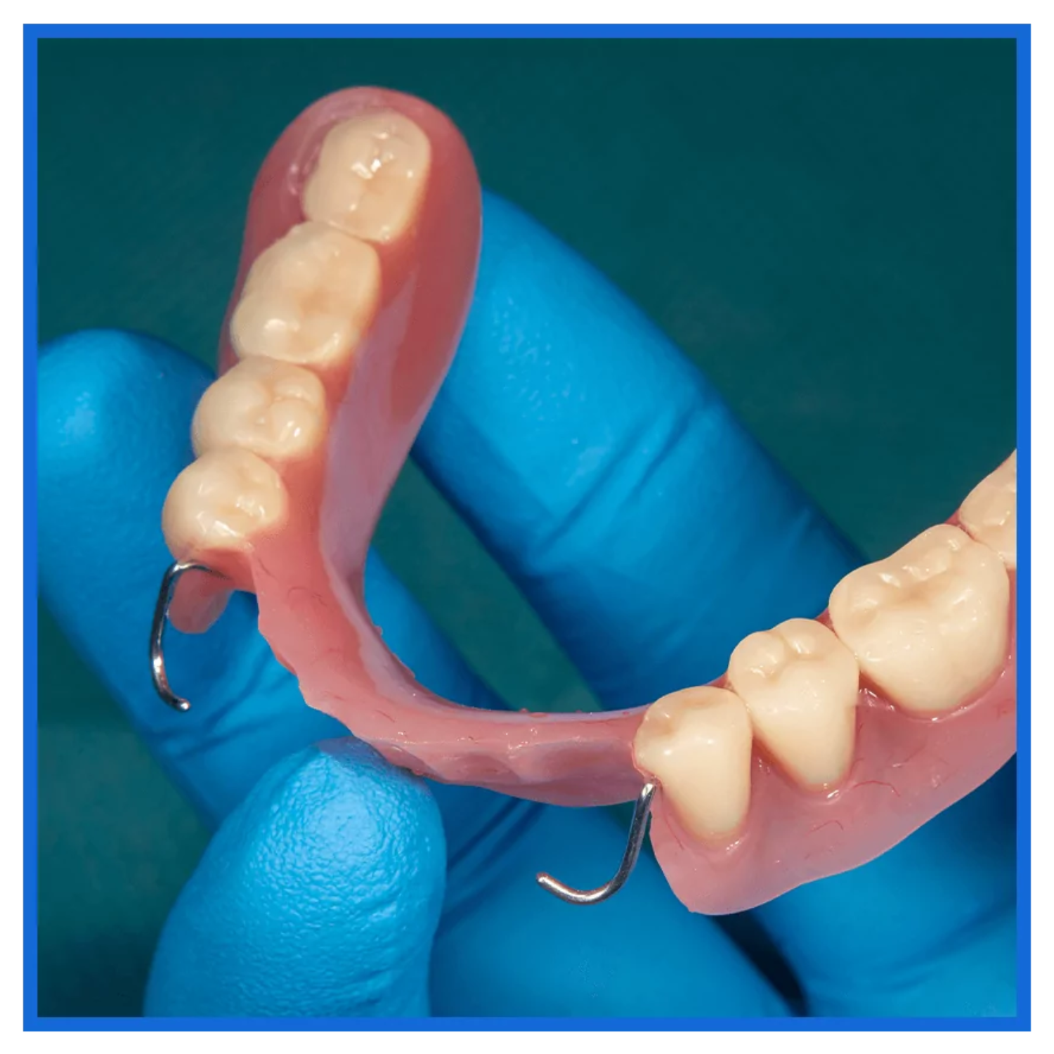 Implant-supported denture with secure attachment system