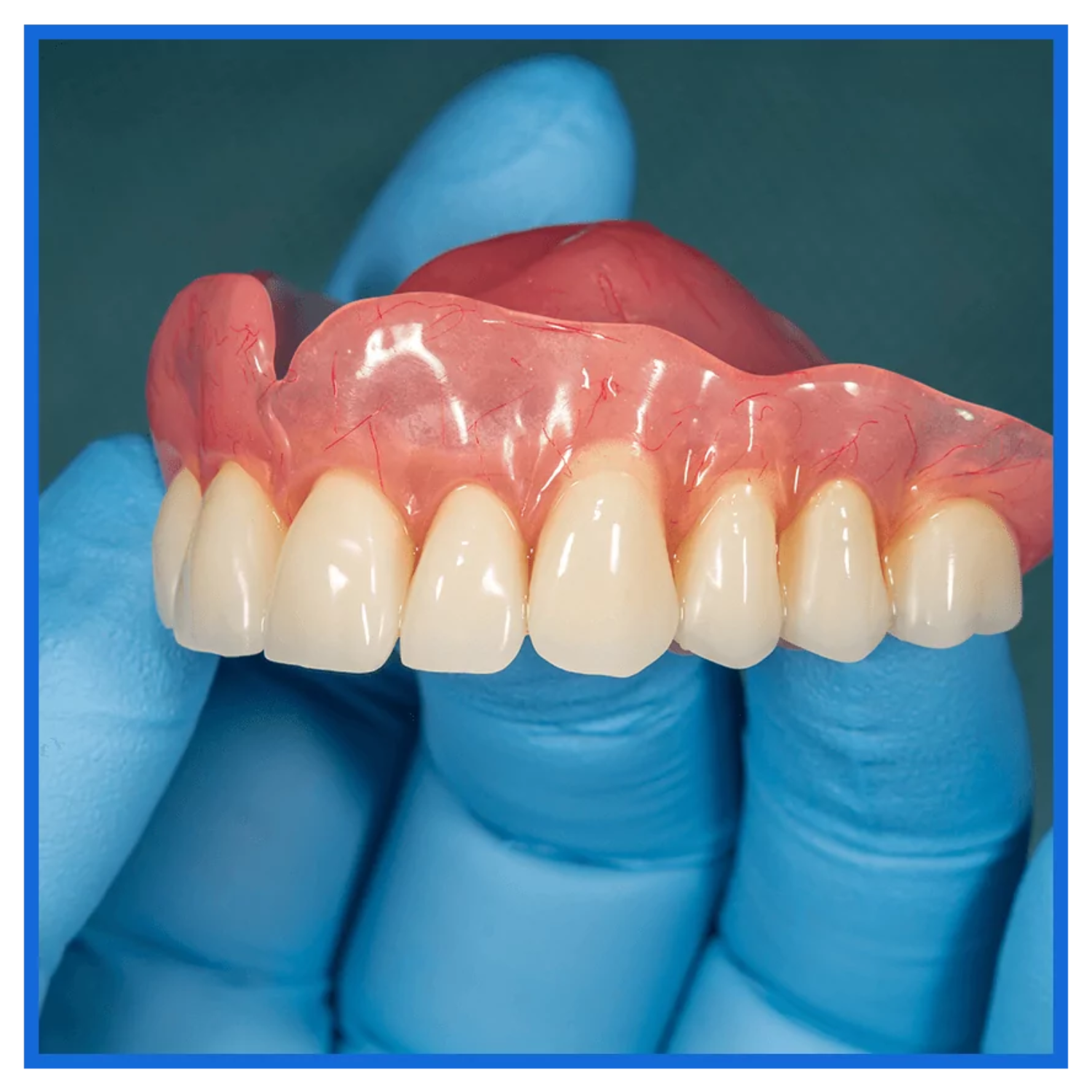 Full upper denture designed for natural appearance and comfortable fit