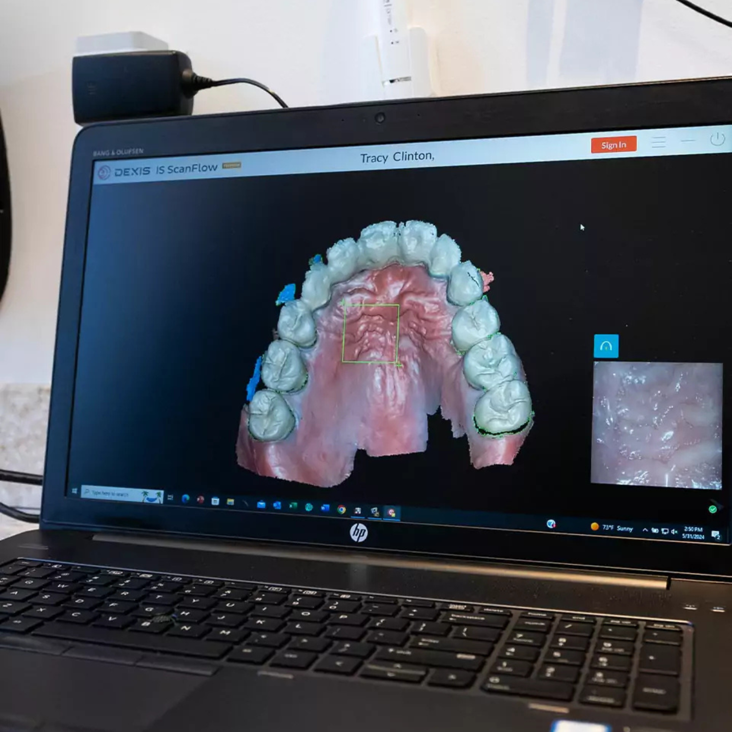 Complete set of custom dentures showing upper and lower prostheses