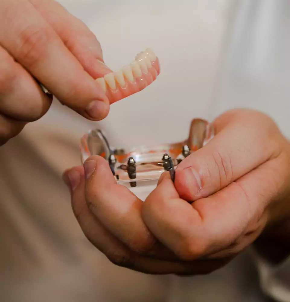 Full Arch Dental Implants demonstration