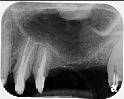 No bone available to receive any implant