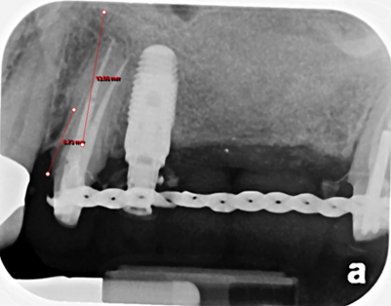 Bone filled-in below sinus membrane