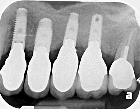 Implants with final abutments and crowns in new bone