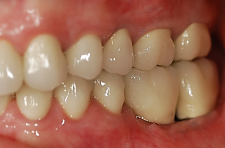 Final abutments and crowns seated on implants