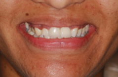 Gummy Smile with Misshaped Crowns