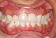 Misshaped Crowns with a Gummy Smile