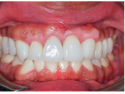 Excess Gum Reshaped with New Crowns