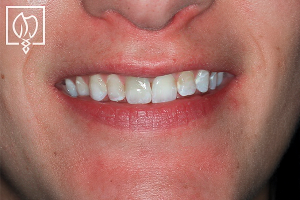 Fig. 1 Severely Mottled Smile Line
