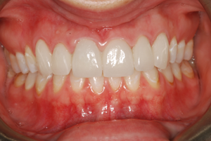 Fig. 3 Crowns Blend with the Thin Gum Tissue