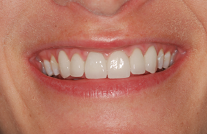 Fig. 4 New Smile Line