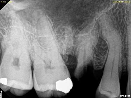 Broken tooth prior to extraction