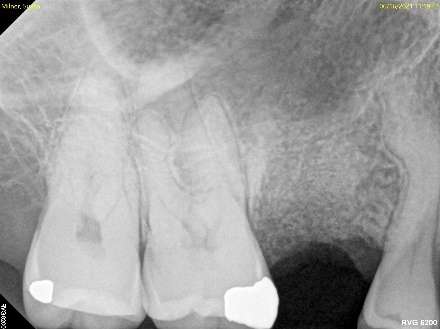 Tooth extracted and bone graft placed