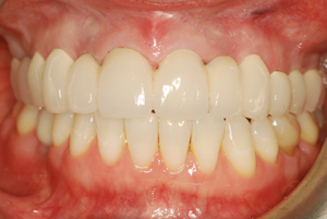 Strong tongue thrust causing crowned teeth to flare