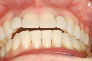 New splinted crowns holding teeth in place