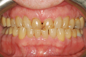 Severe grinding habit causing years of wear