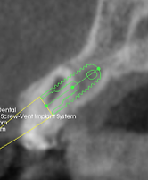 Atrophied 5.6 mm ridge at severe angle