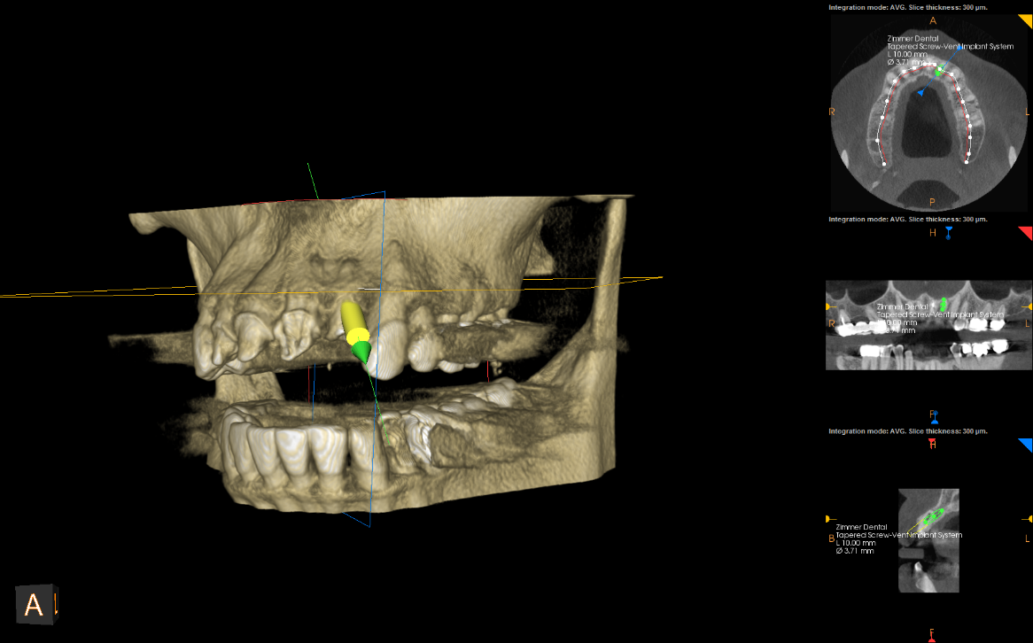 Implant planning at 45 degrees
