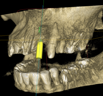 Precise implant placement in ideal position