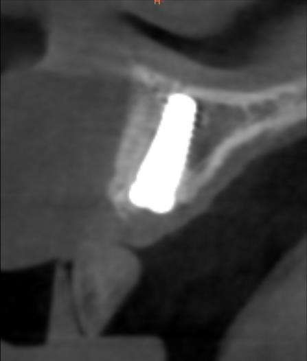 Bone graft placed, adding 4 mm of new bone