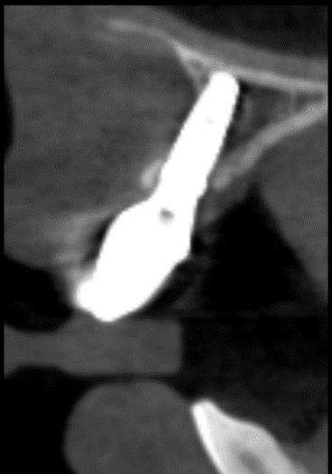 Implant missing bone on its outside surface