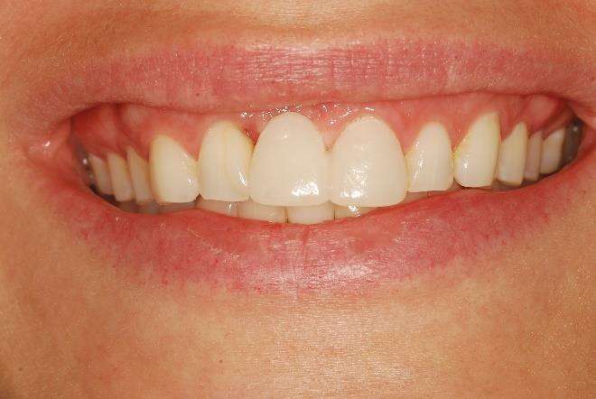 Temporary crown seated over the grafted implant