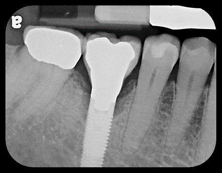 Bone graft repair, 4 months later healing, and 6 year follow-up