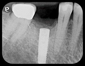Failing implant with bone loss around it
