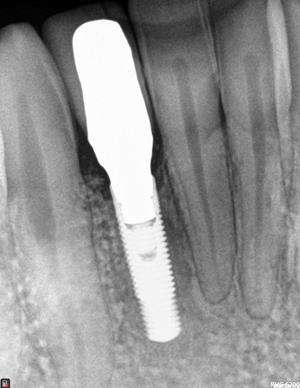 Bone graft placed at failed implant site